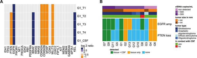 Detection of somatic copy number alterations in cerebrospinal fluid (CSF) is influenced by tumor grade, cfDNA concentration, and contact between the tumor and CSF.