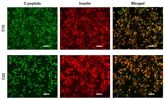 hiPS cell-derived beta cells synthesize insulin