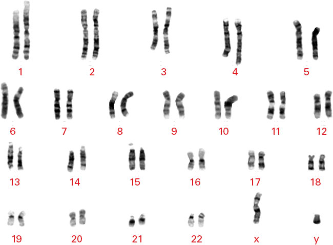 Edited hiPS cell clones maintain a stable karyotype